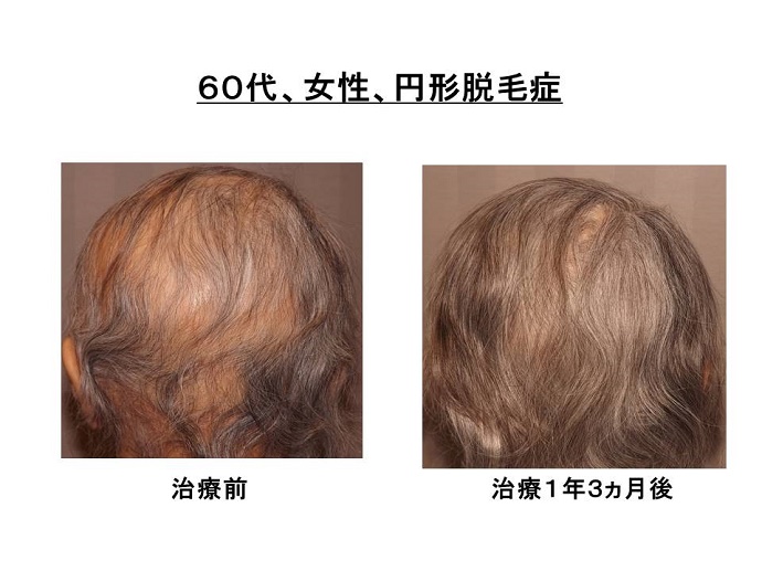 円形脱毛症　病院""
